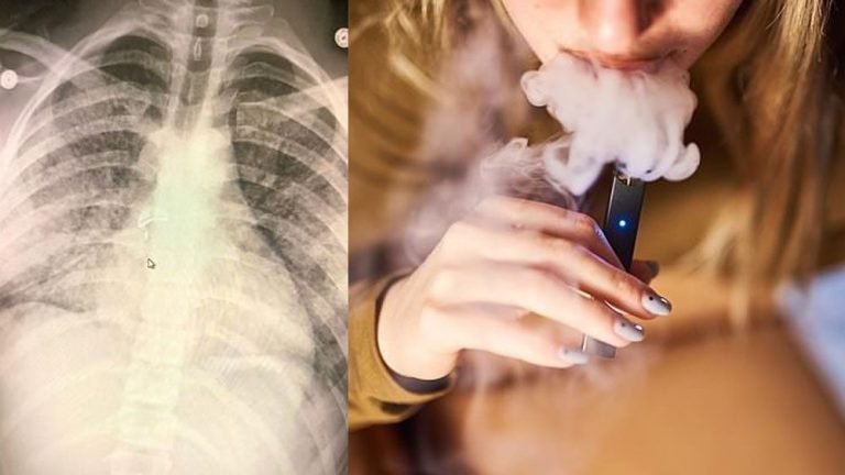 La Nueva Crisis Pulmonar A Causas Del ‘vapeo Deja Al Menos 4 Muertos Y 450 Enfermos Santa 2018