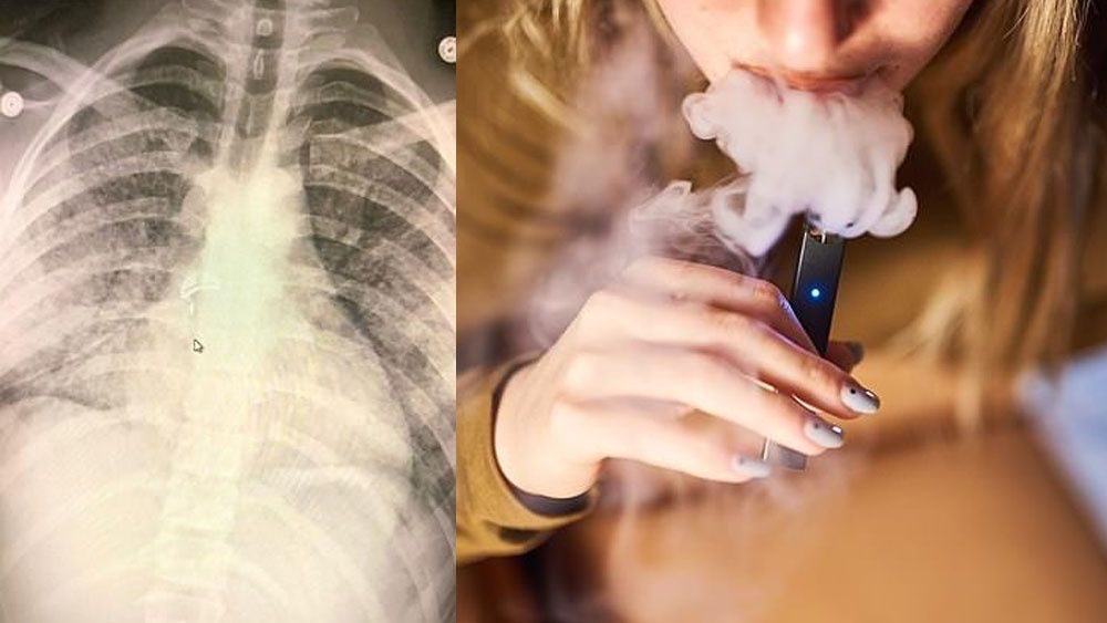 La Nueva Crisis Pulmonar A Causas Del Vapeo Deja Al Menos Muertos Y